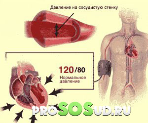 Артериальная гипертония