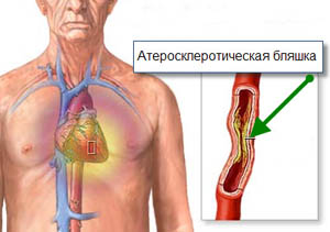 атеросклеротическая бляшка