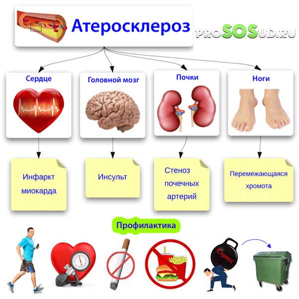 профилактика атеросклероза