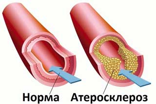 атеросклероз