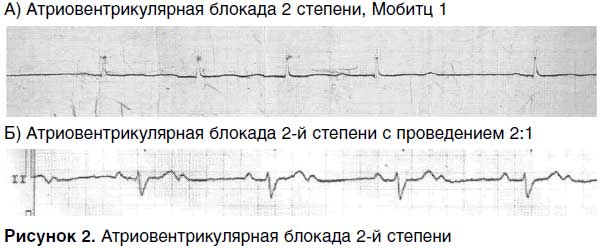 атриовентрикулярная блокада сердца 2 степени