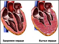 увеличенное сердце