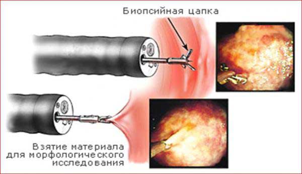биопсия