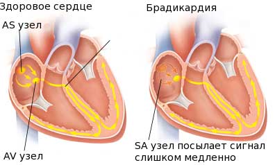 брадикардия сердца