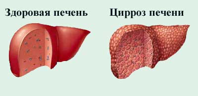 цирроз печени