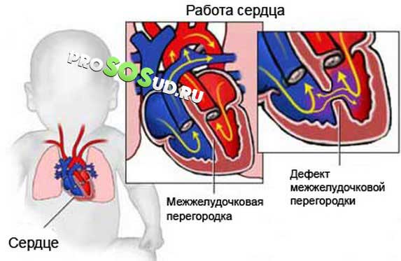 Дефект межжелудочковой перегородки