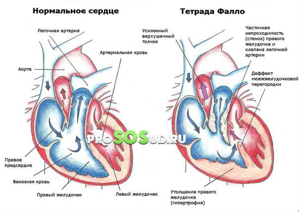 дефект сердца