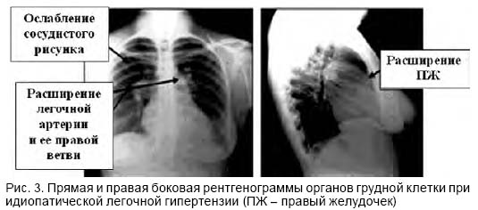 диагностика лёгких