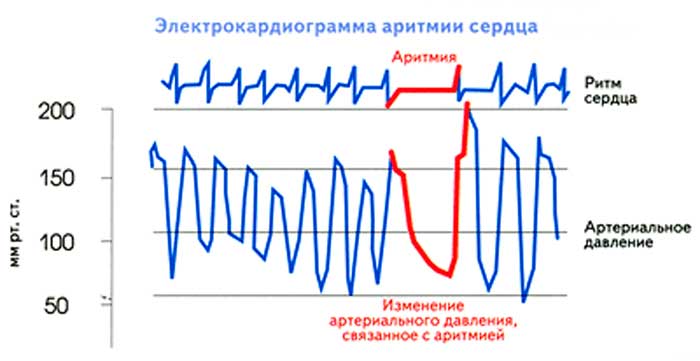 экг аритмии сердца