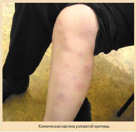 проявление узловатой эритемы на колене