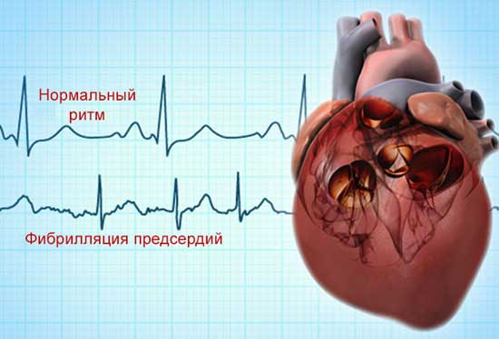 фибрилляция предсердий