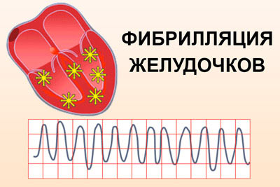 фибрилляция желудочков