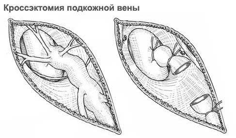 кроссэктомия подкожной вены