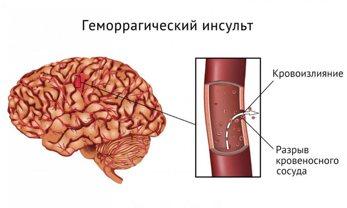 геморрагический инсульт