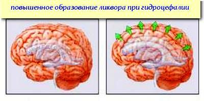 гидроцефалия