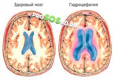  гидроцефалия