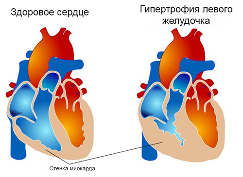 гипертрофия миокарда