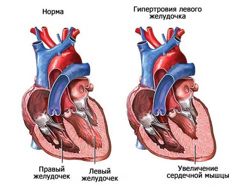гипертрофия сердца