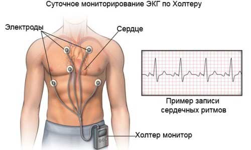 холтеровское мониторирование