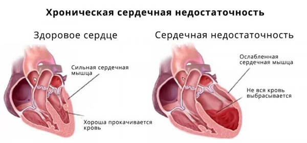 ХСН