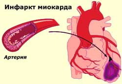 инфаркт миокарда