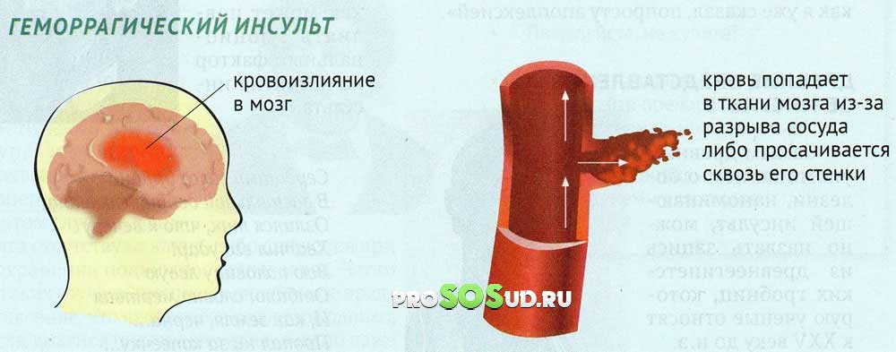 разрыв сосуда в мозге