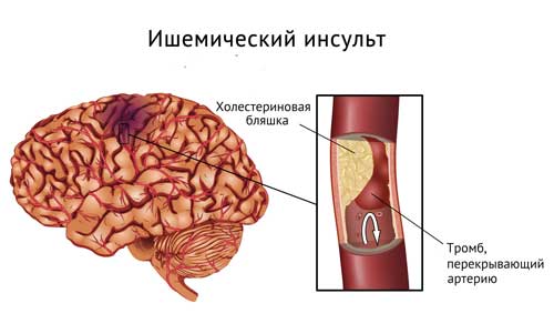 ишемия