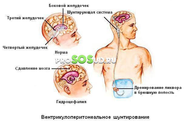 гидроцефалия