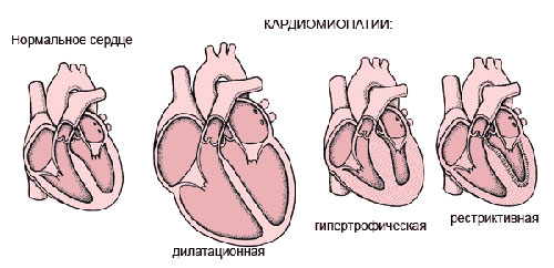 кардиомиопатия