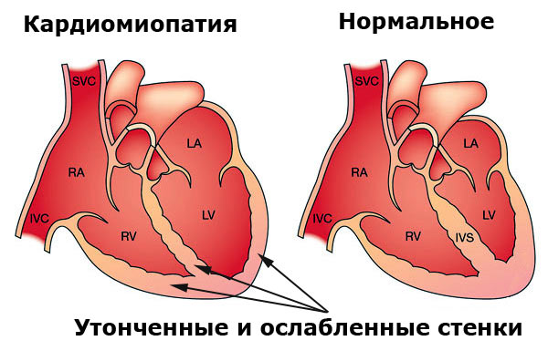 кардиомиопатия