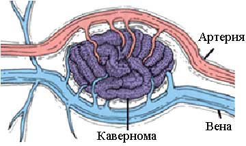 кавернома