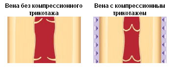 вены с компресионым трикотажем и без