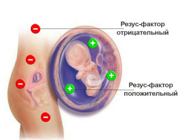 конфликт резус факторов