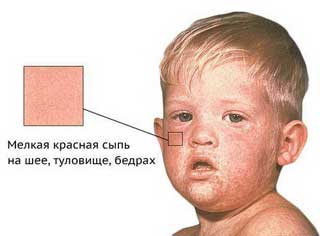 краснуха у ребенка