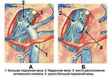 Кроссэктомия