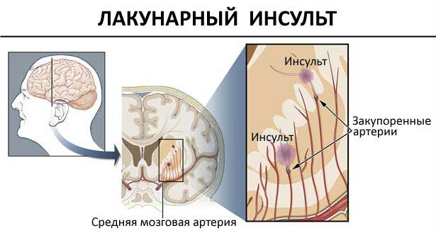 лакунарный инсульт