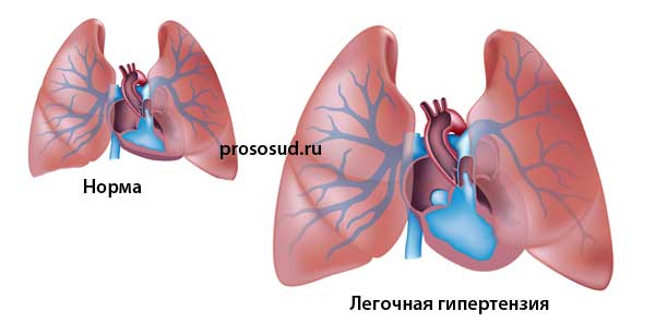легочная гипертензия
