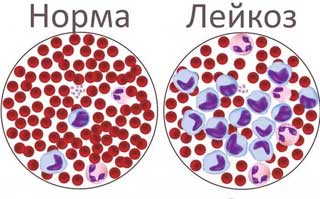 лейкоз