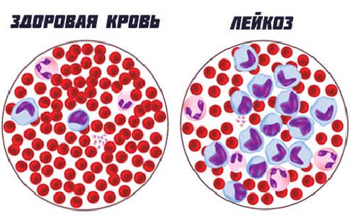 здоровая кровь и заражённая
