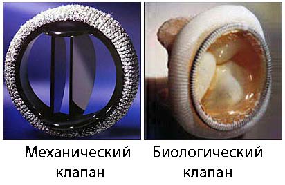 механический клапан сердца