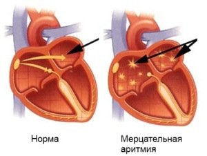Мерцательная аритмия