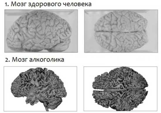 мозг алкоголика
