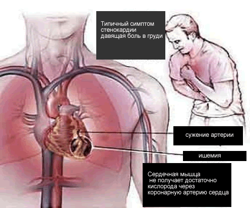 причины стенокордии