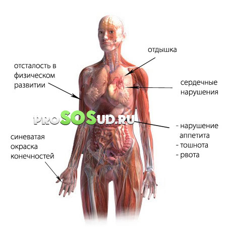 нейроциркуляторная дистония