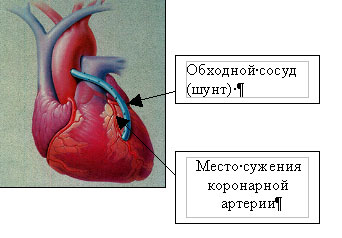 обходной сосуд