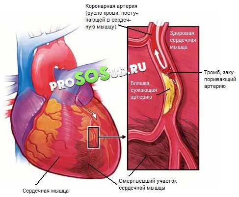 закупорка артерии сердца