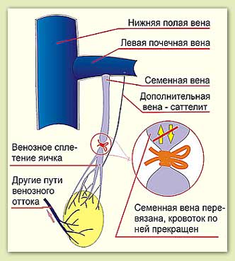 Операция Иваниссевича