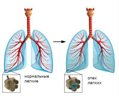 отек лёгких