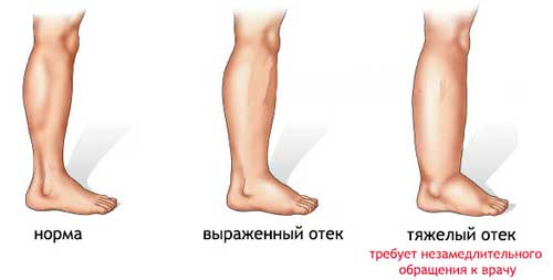 отеки ног