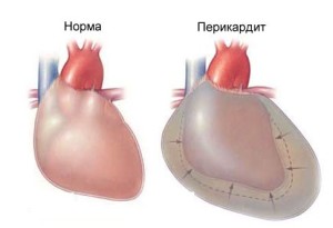 перекардит